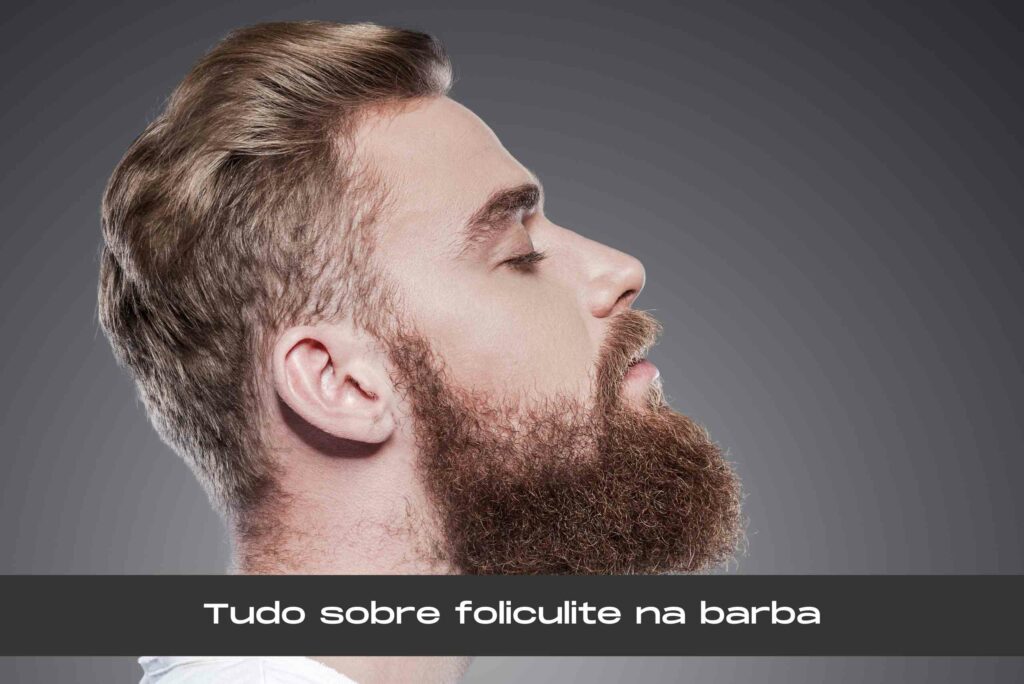 Foliculite na barba