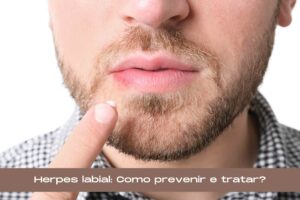 herpes labial